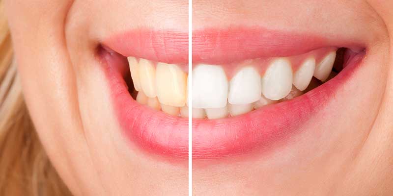 teeth close up before and after laser tooth whitening treatment