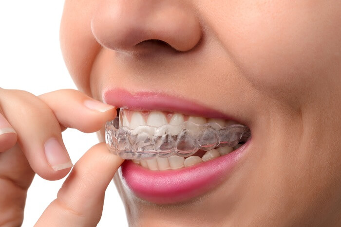 Best Invisalign Dentist Invisalign Clear Braces in Milton ON