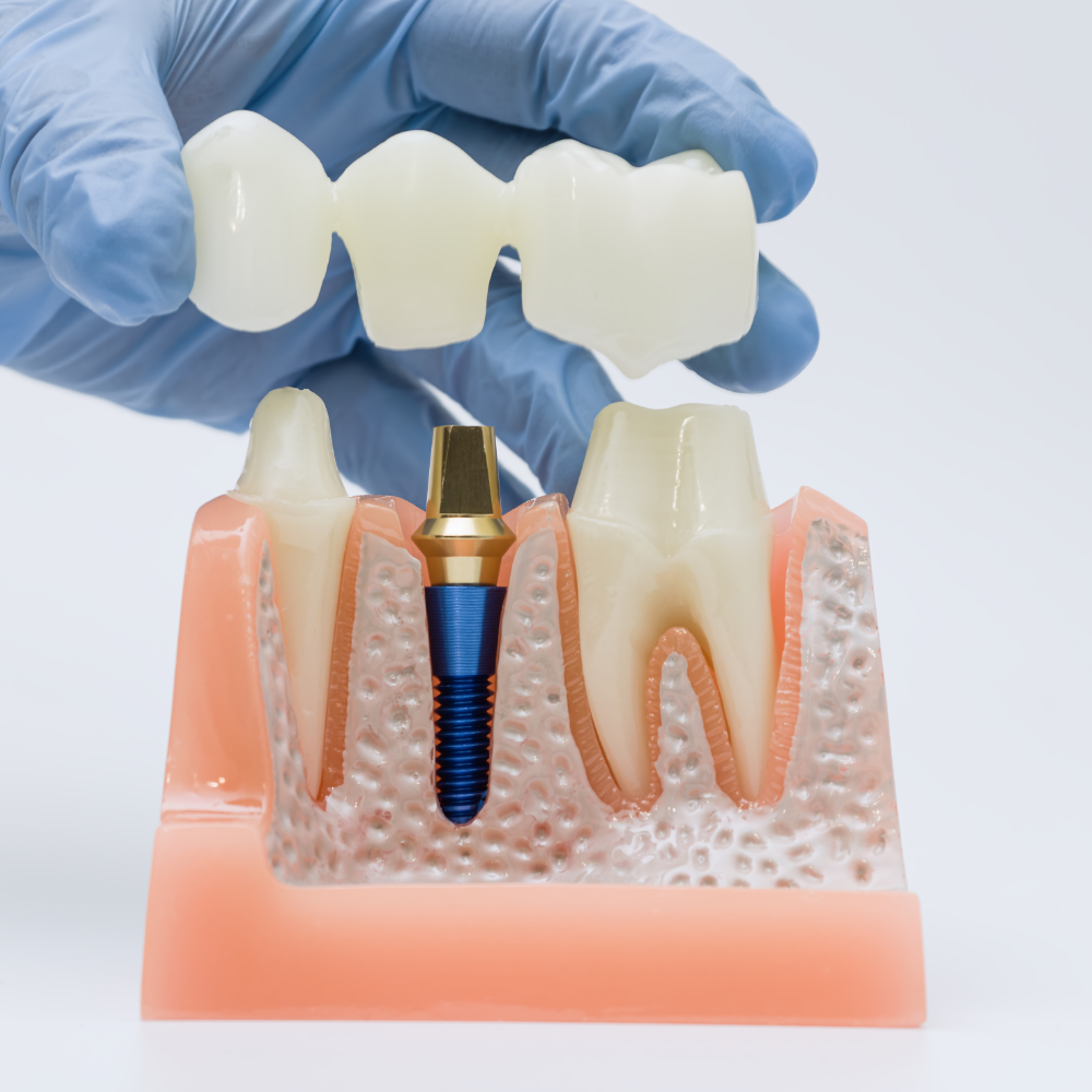 Bone Grafting for Dental Implants
