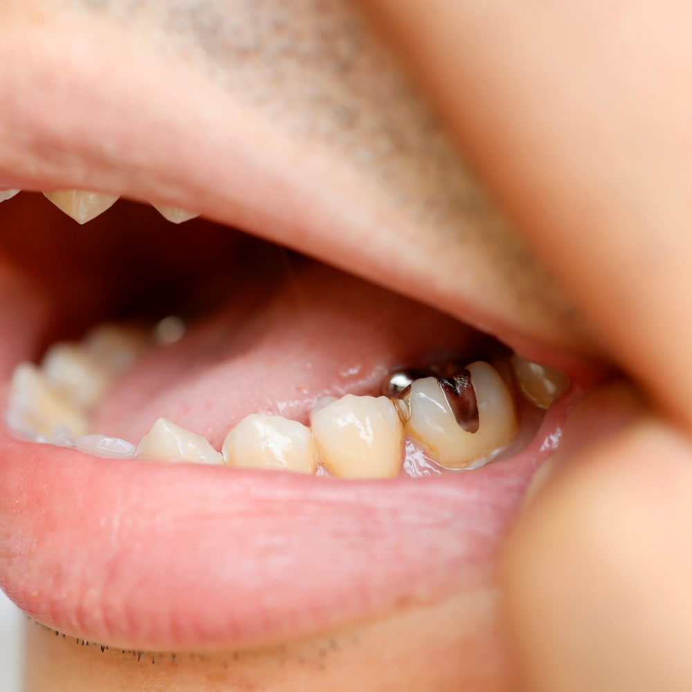 Broken Dental Fillings & Crowns Repair