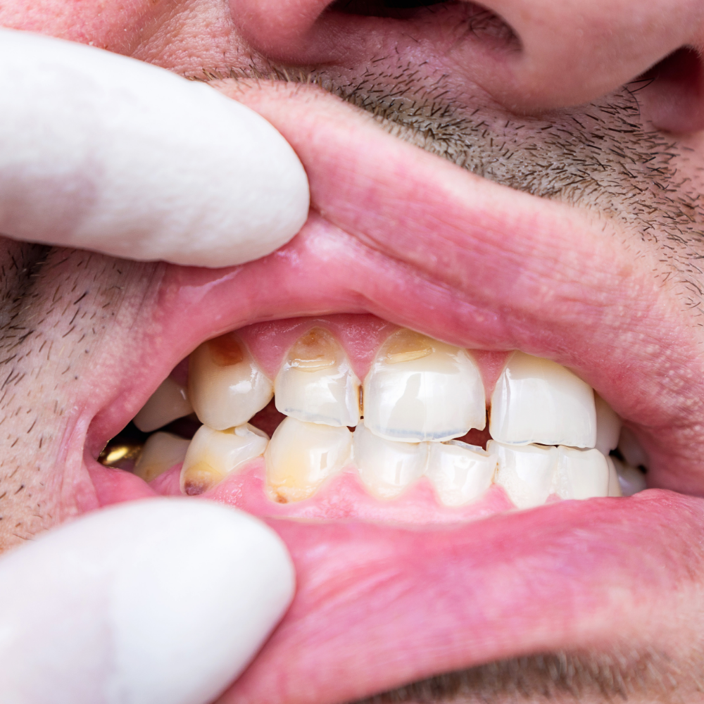 Broken or Chipped Tooth Repair