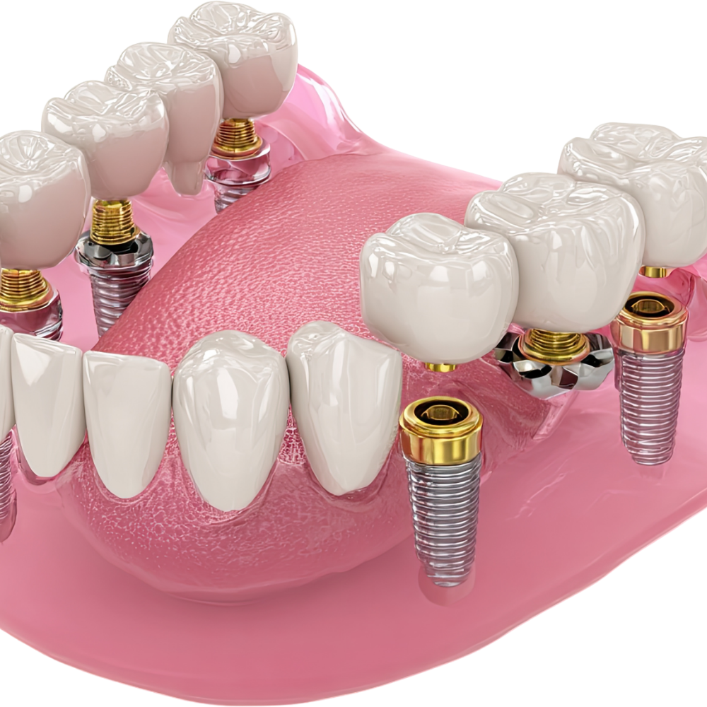 Multiple Teeth Dental Implants