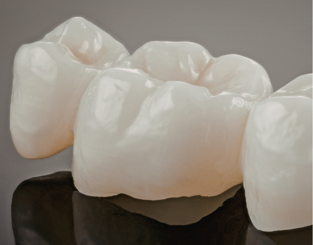 cosmetic dental crowns milton 1