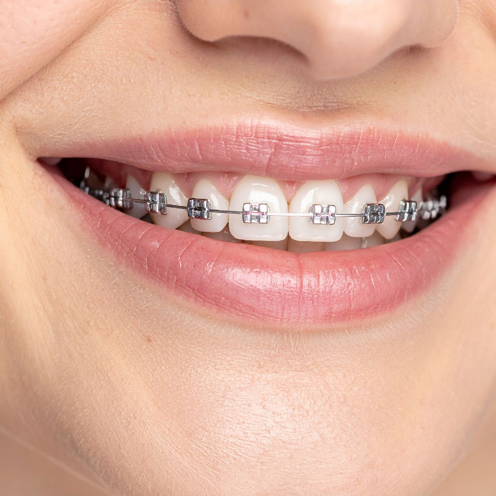 orthodontic consultation milton