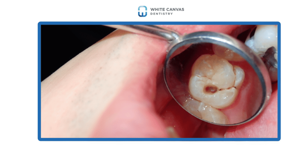 What to Do for a Lost Filling or Crown